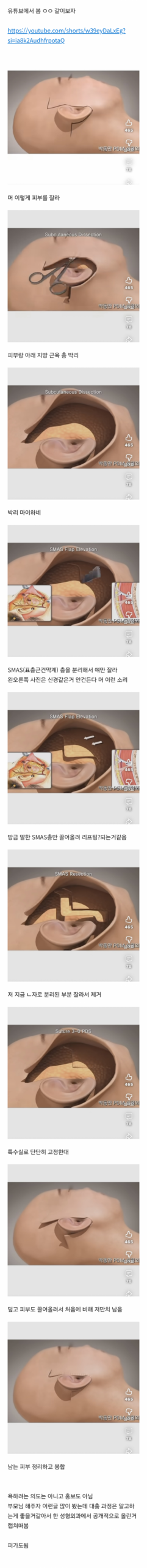 Detailed surgical diagram of the SMAS layer being lifted and repositioned during a Seoul Lift procedure.