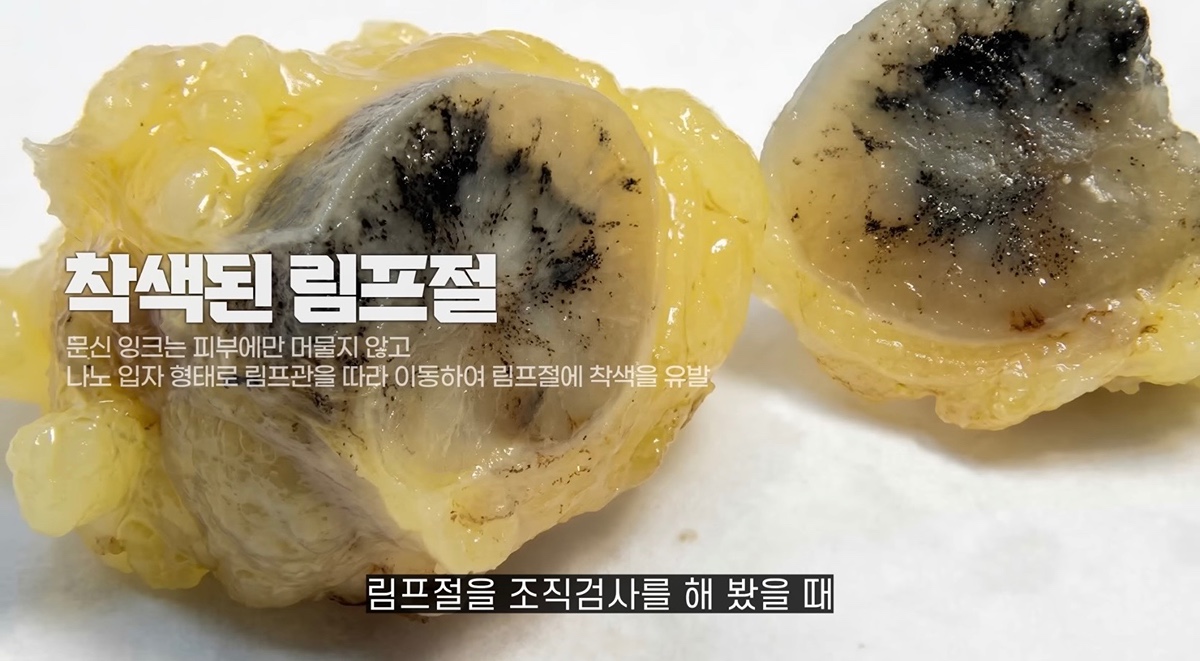 タトゥー除去後のインクの行方とリンパ節への蓄積に関する解説図