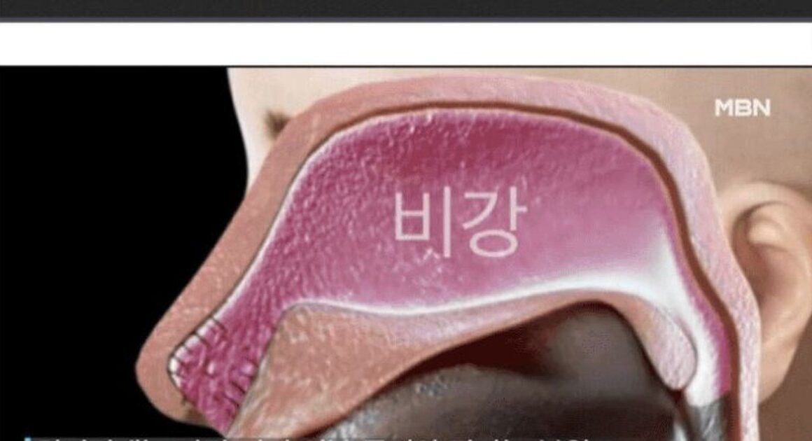 The Dark Side of Rhinitis Surgery: Empty Nose Syndrome